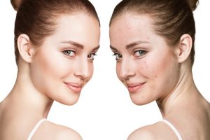 How to Use Retinol in Acne Treatment