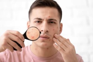 What Does Hyaluronic Acid Do for Acne?