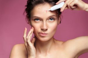 Does Salicylic Acid Fight Acne?